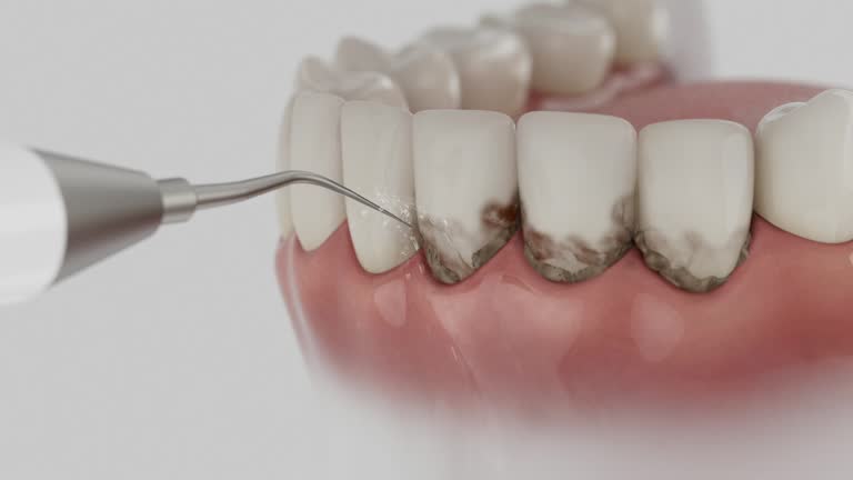 Trusted Invisalign Clear Aligners service in Englewood, OH - Dentist Open Now